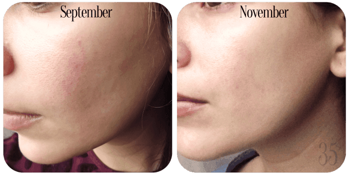 Sau ba tuần sử dụng, da bạn được cải thiện rõ rệt. (Ảnh: Internet)