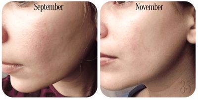 Sau ba tuần sử dụng, da bạn được cải thiện rõ rệt. (Ảnh: Internet)
