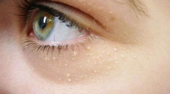 Không tẩy da chết vùng mắt là một nguyên nhân gây mụn thịt (Ảnh: Internet)
