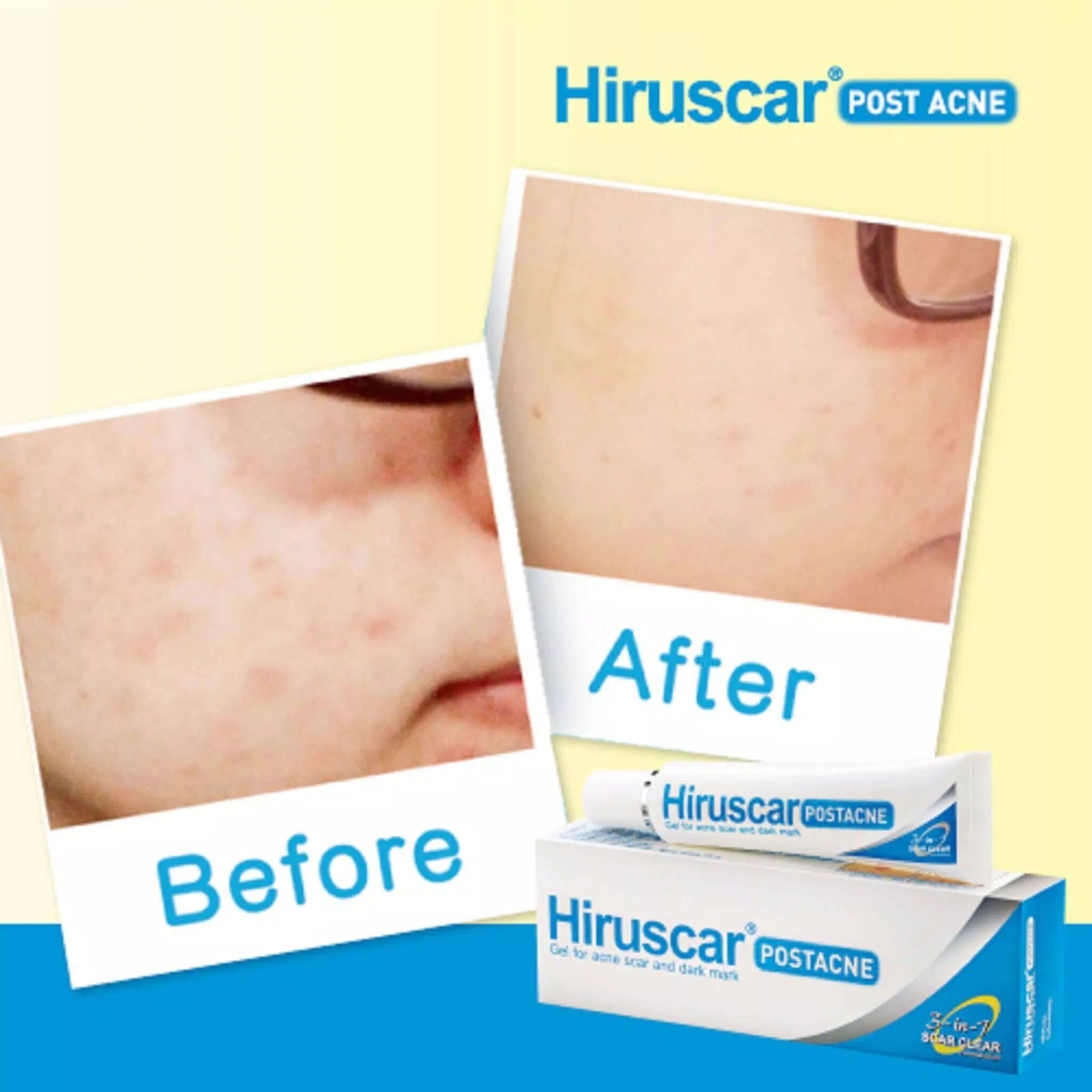 Hiruscar Post Acne