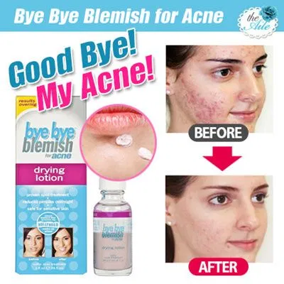 Kem trị mụn Bye Bye Blemish