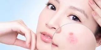 7 cách giảm sưng mụn tại nhà cho da mịn màng