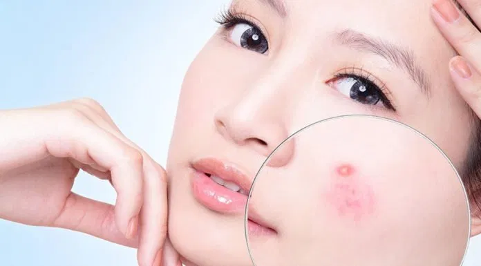 7 cách giảm sưng mụn tại nhà cho da mịn màng