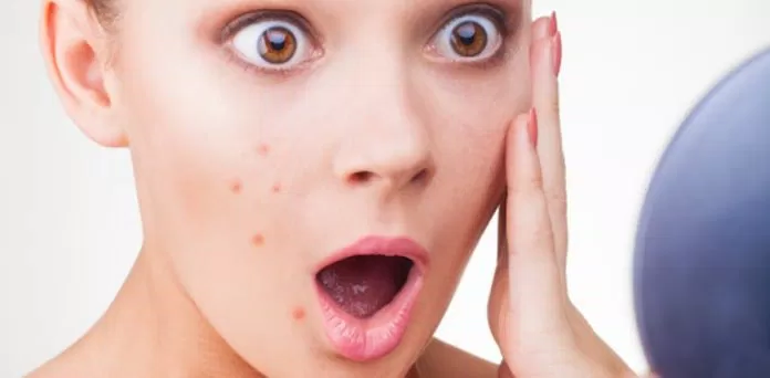 7 cách giảm sưng mụn tại nhà cho da mịn màng
