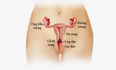 ung thư cổ tử cung