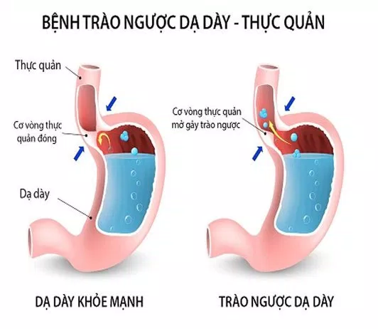 ho khan ngứa cổ