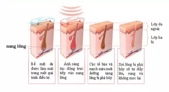 triệt lông vĩnh viễn
