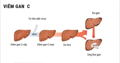 Viêm gan C