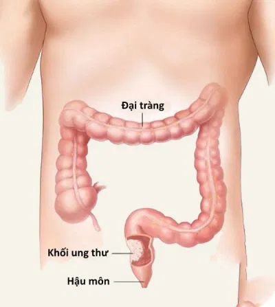 Ung thư