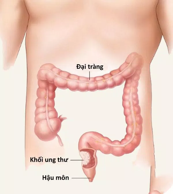 Ung thư