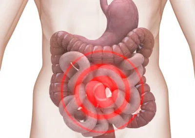 Hội chứng ruột kích thích