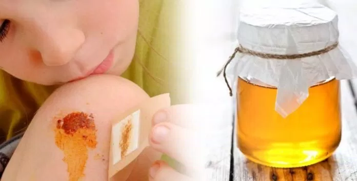 Mật ong trị thương