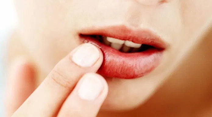 Môi đỏ nứt nẻ