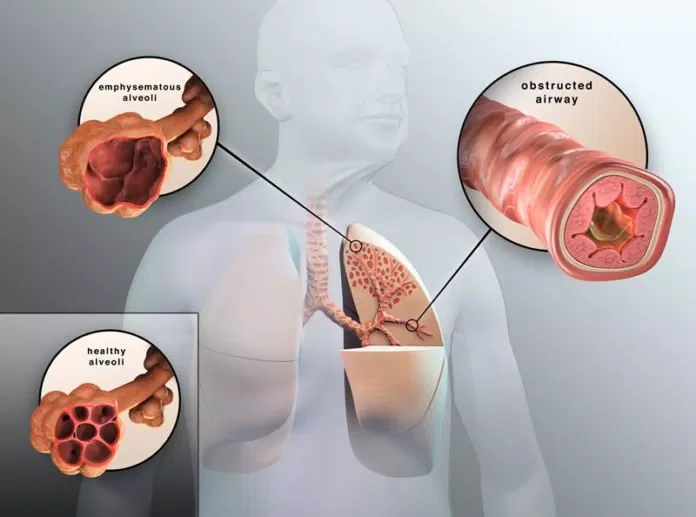 Phổi tắc nghẽn mãn tính