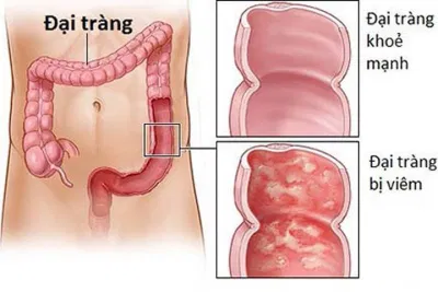 Viêm đại tràng
