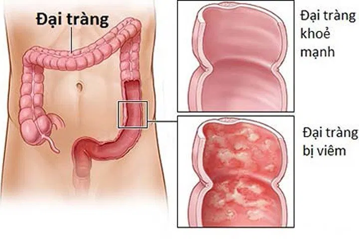 Viêm đại tràng