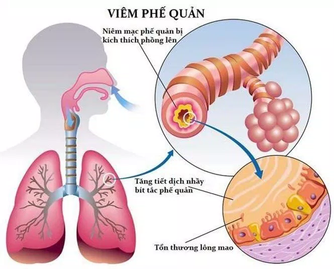 Viêm phế quản