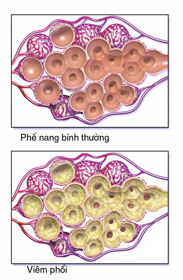 Viêm phổi