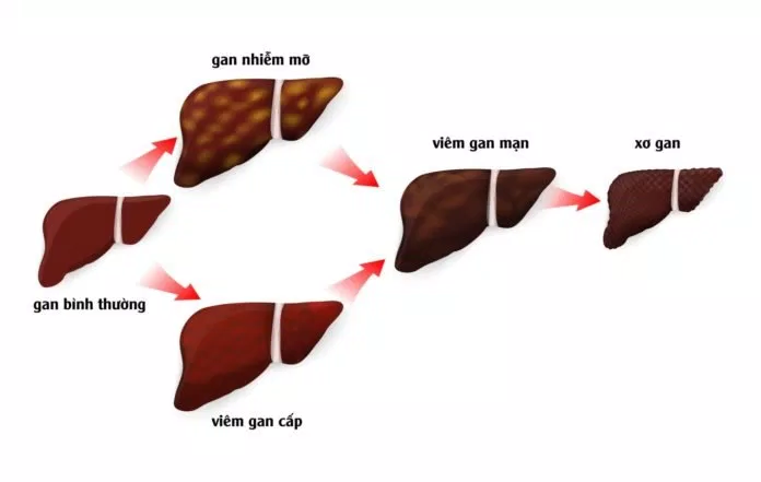 Bệnh về gan