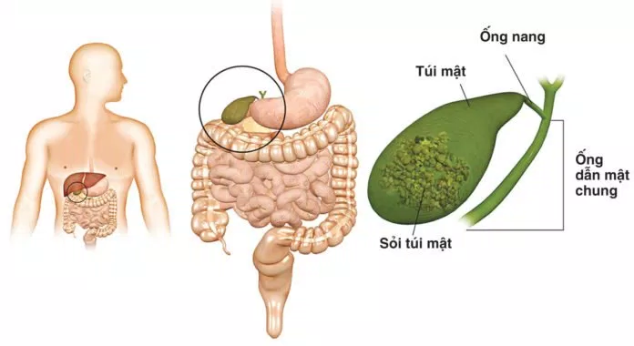 sỏi mật