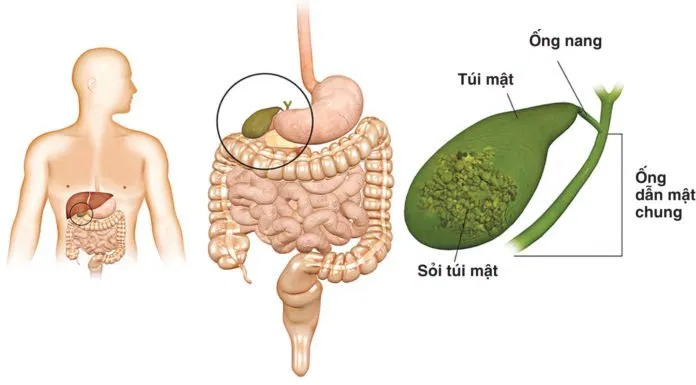 sỏi mật