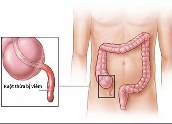 viêm ruột thừa