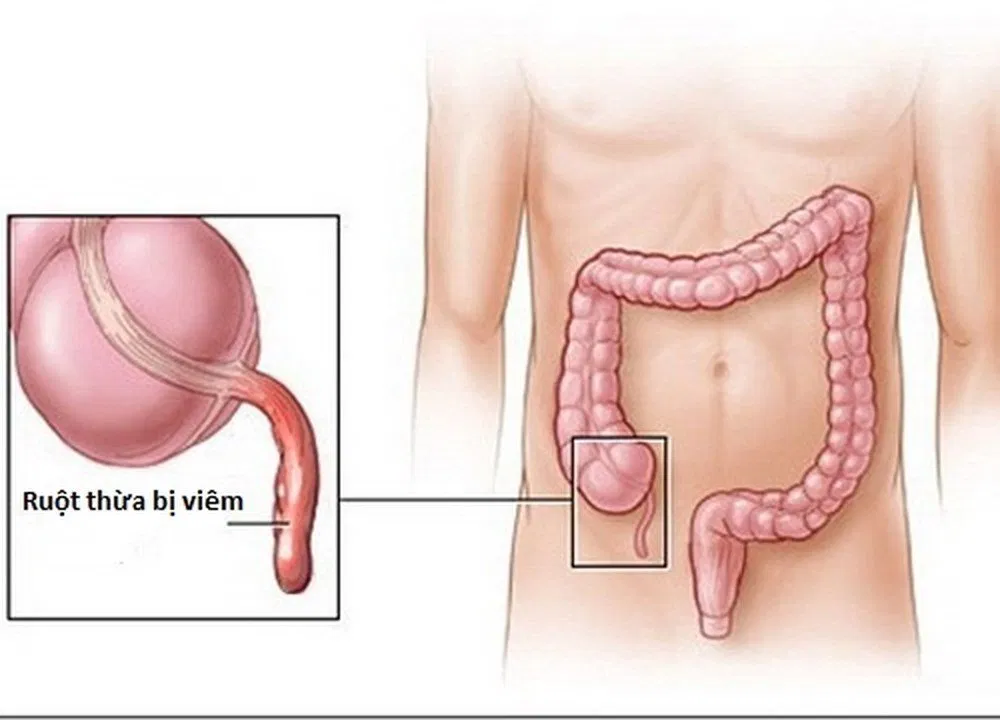 viêm ruột thừa