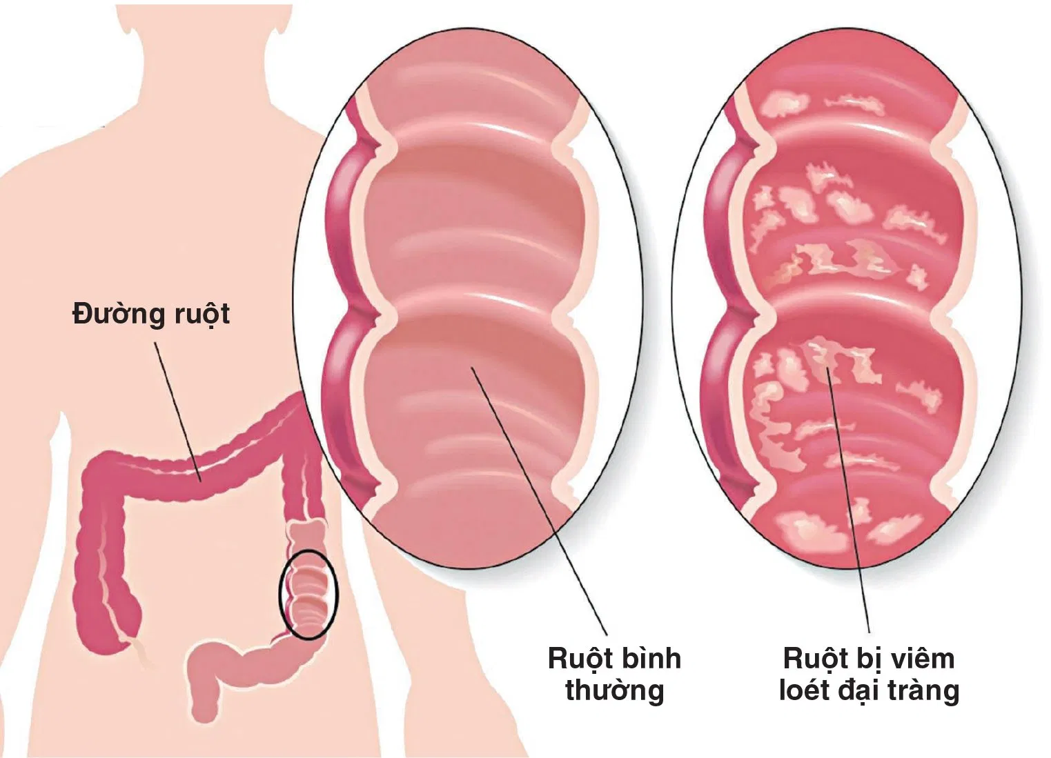 viêm trực tràng