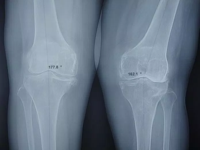 Xquang thoái hóa khớp