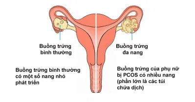 bệnh buồng trứng đa nang