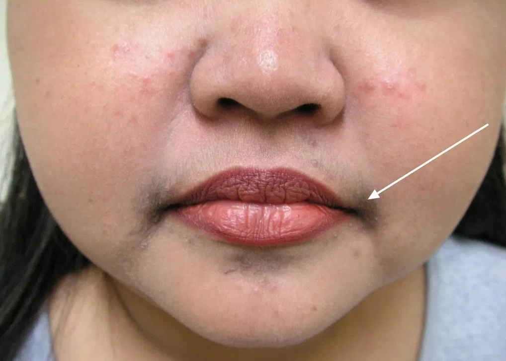 bệnh PCOS