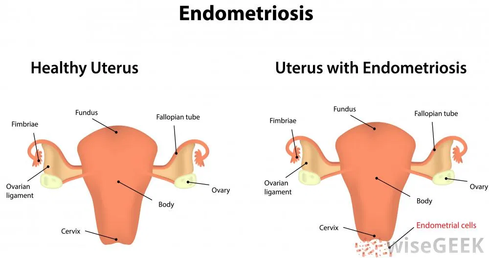 endometrosis