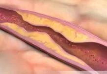 Máu nhiễm mỡ