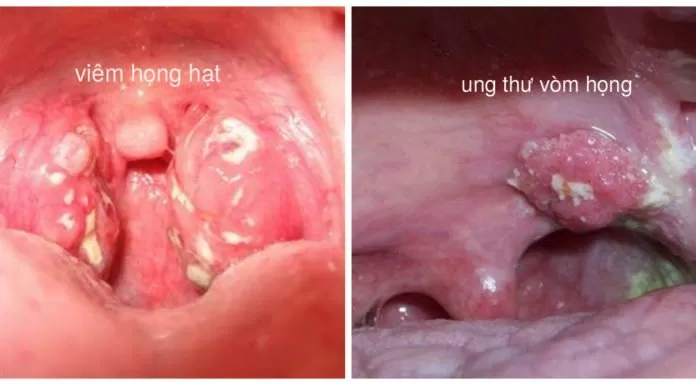 phân biệt viêm họng hạt và ung thư vòm họng