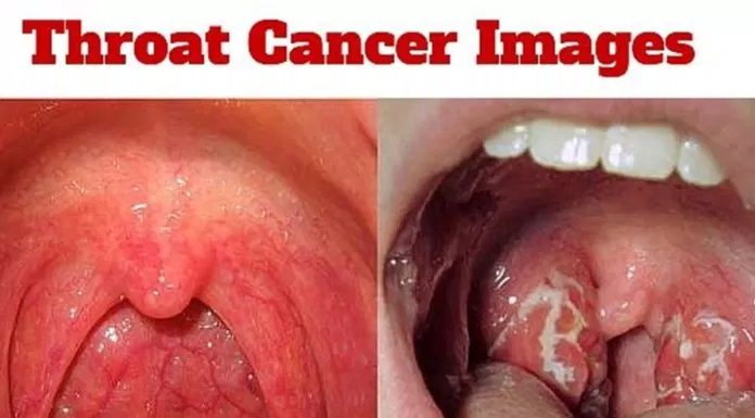 Hình ảnh ung thư vòm họng giúp bạn dễ dàng nhận biết tình trạng bệnh hình ảnh ung thư vòm họng ho khan thay đổi giọng nói triệu chứng ung thư vòm họng ung thư vòm họng
