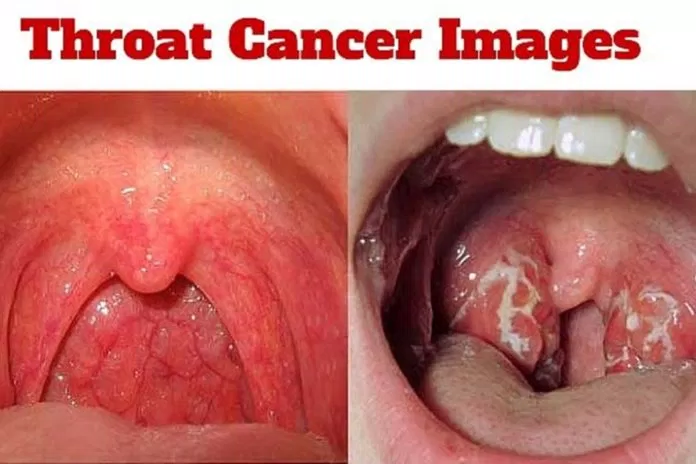 Hình ảnh ung thư vòm họng giúp bạn dễ dàng nhận biết tình trạng bệnh hình ảnh ung thư vòm họng ho khan thay đổi giọng nói triệu chứng ung thư vòm họng ung thư vòm họng