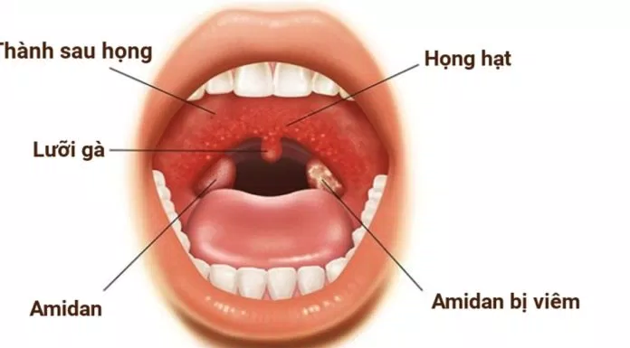 Triệu chứng viêm amidan cần nhận biết để chữa trị sớm