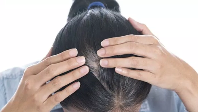 Nguyên nhân tóc bạc sớm