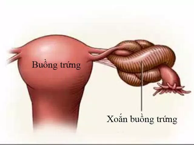 u nang buồng trứng