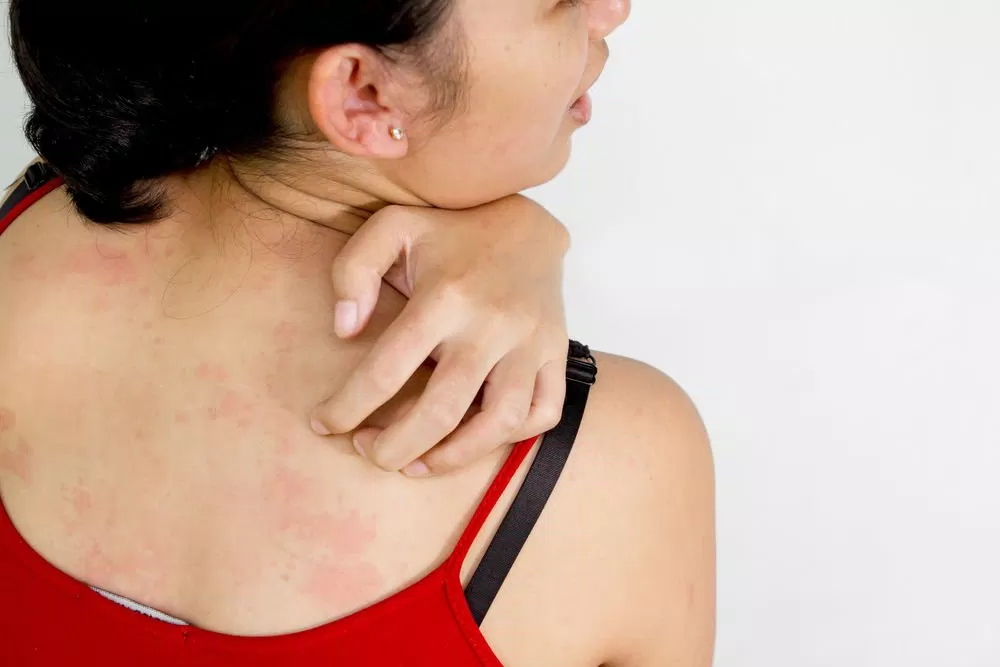 Dị ứng thời tiết