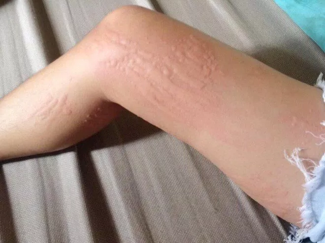 Dị ứng thời tiết