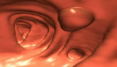 Polyp trực tràng