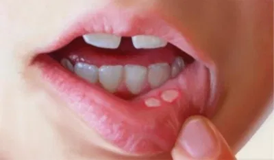 Nhiệt miệng