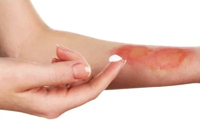 Cách chữa bỏng tại nhà