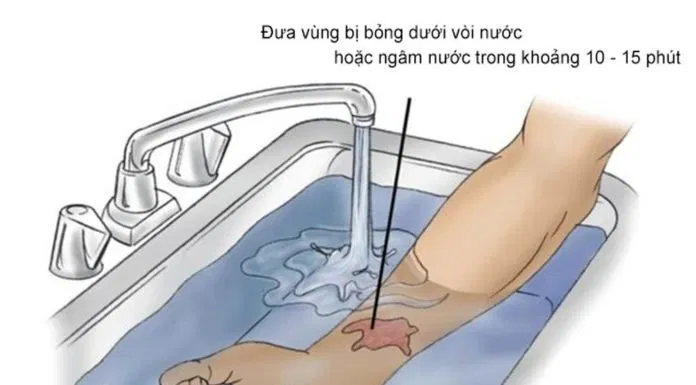 Cách chữa bỏng tại nhà