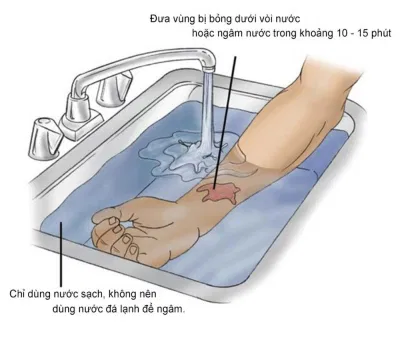Cách chữa bỏng tại nhà