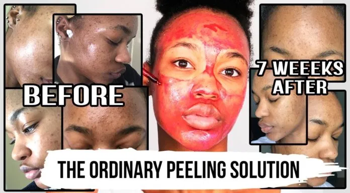 The Ordinary AHA 30% + BHA 2% Peeling Solution