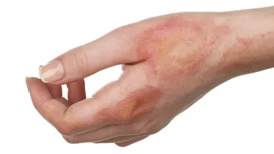 Cách chữa bỏng tại nhà