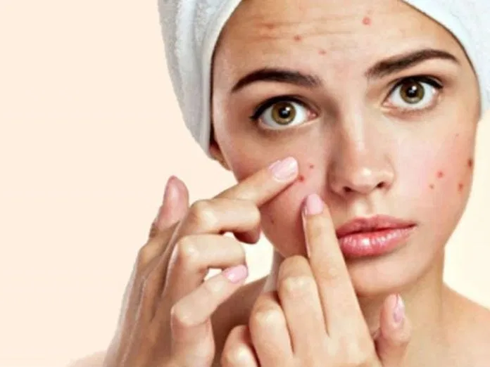 Mụn trứng cá vẫn có thể xuất hiện ngay cả khi bạn đã hết giai đoạn dậy thì (Nguồn: Internet)