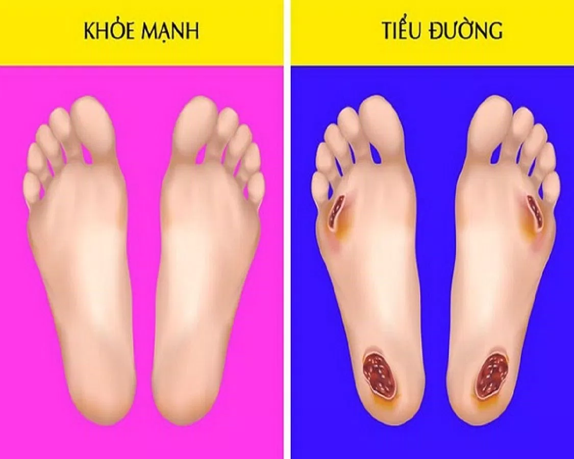 Bàn chân đái tháo đường